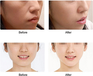 Vananemisvastane massaaziapparaat näole /Facelift anti-aging (7 foto / 7)