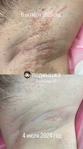 ЛАЗЕРНАЯ ЭПИЛЯЦИЯ (1 фото из 4)