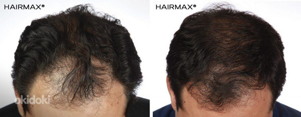 Курс против выпадения волос (фото #9)