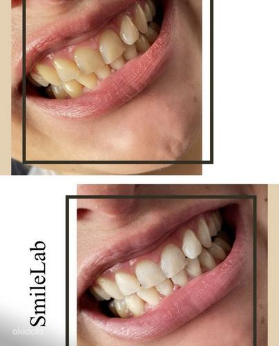 Отбеливание зубов (фото #2)