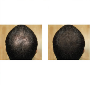 VAHT | FOLIGAIN Minoxidil 5% Juuste kasvu vaht meestele (4 foto / 5)