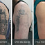 Tattoo eemaldamise laser (foto #2)