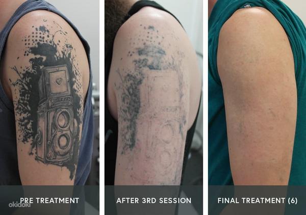 Tattoo eemaldamise laser (foto #2)
