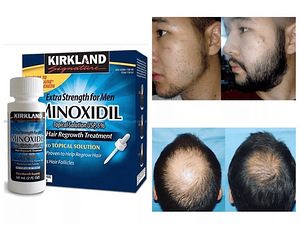 Minoksidiil 100% originaal Minoxidil (2 foto / 2)